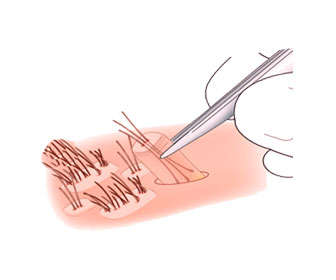 injerto de pelo en coronilla o trasplante capilar en la parte posterior de la cabeza
