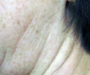 deficiencia de silicio