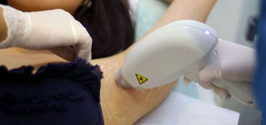 depilacion laser diodo