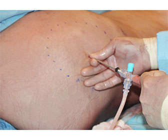 gluteoplastia inyeccion de grasa