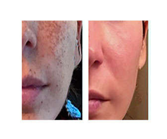 hidroquinona antes y despues