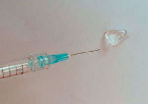 infiltracion acido hialuronico