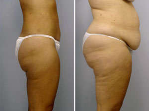 lipectomia con liposuccion