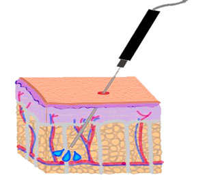 lipoaspiracion