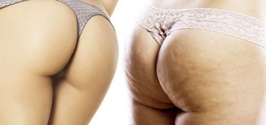 lipolaser opiniones