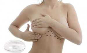 mamoplastia