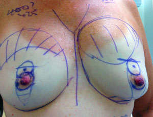 mamoplastia riesgos