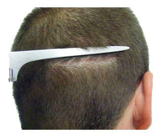 solución a la alopecia Solución a la alopecia femenina y masculina androgénica y areata ¿Es definitiva? micro-injerto capilar