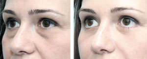 ojeras y bolsas remedio