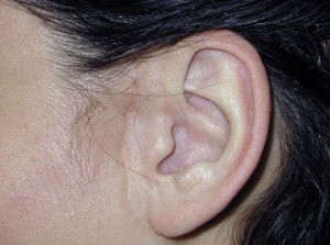 otoplastia sin cirugia