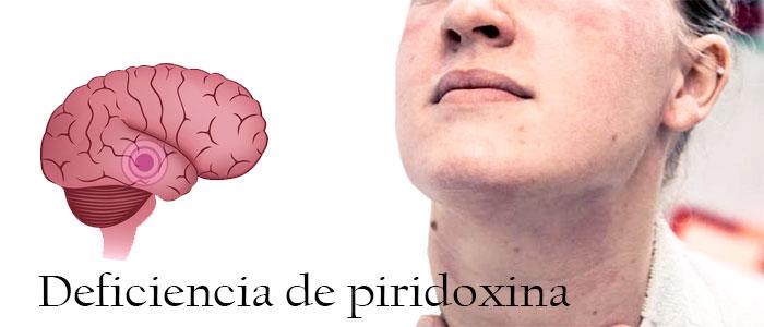 Deficiencia de piridoxina