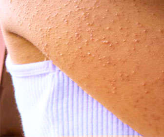 queratosis pilaris o pilar