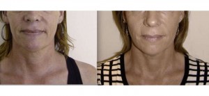 rejuvenecimiento facial resultados