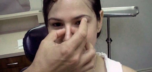 rinoplastia postoperatorio