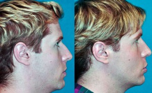 rinoplastia seguridad social