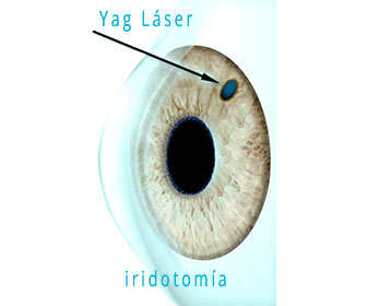 yag laser iridotomia